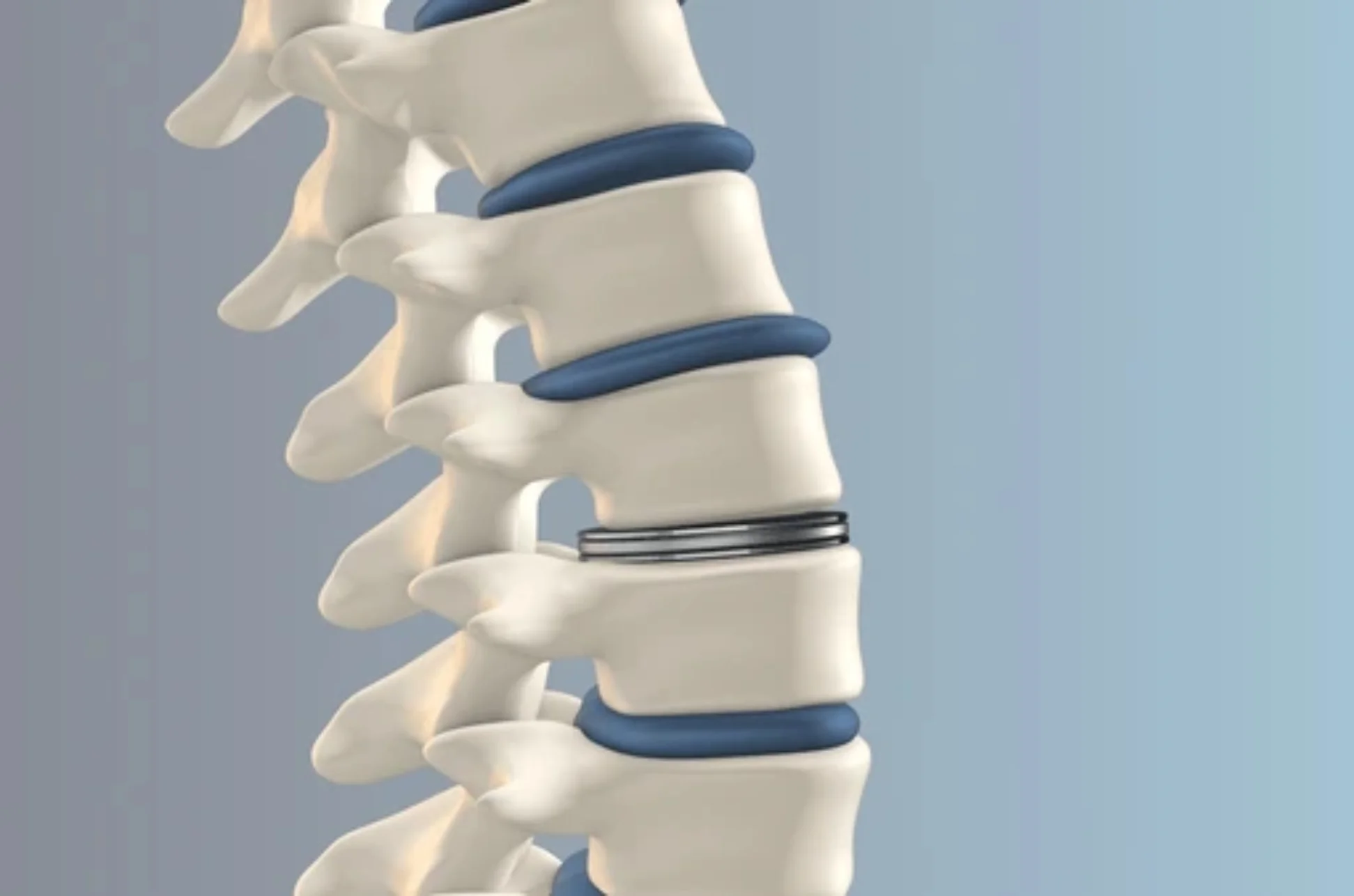 Disc Replacement Surgery