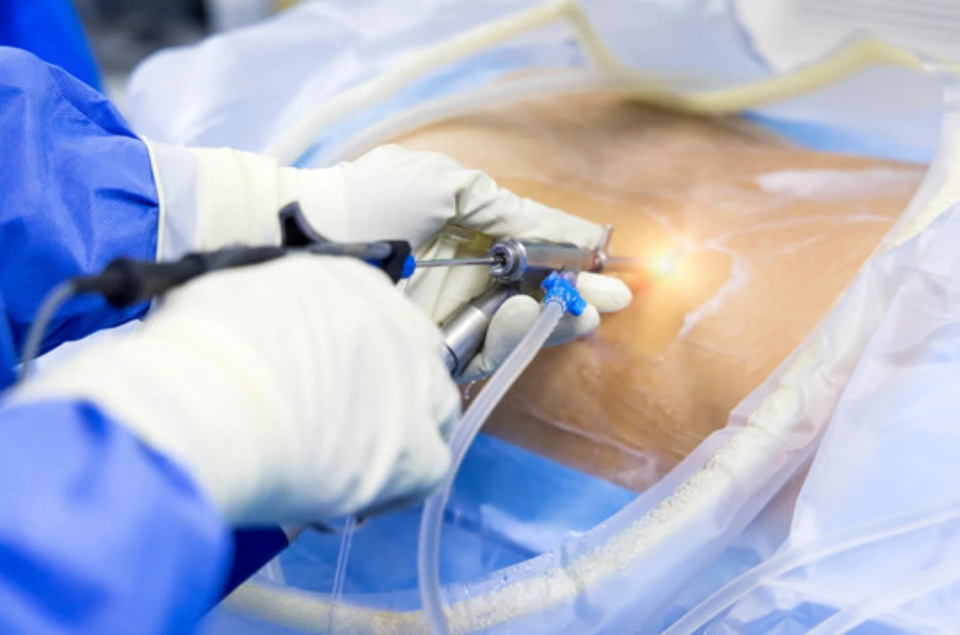 Minimally Invasive Surgery----05