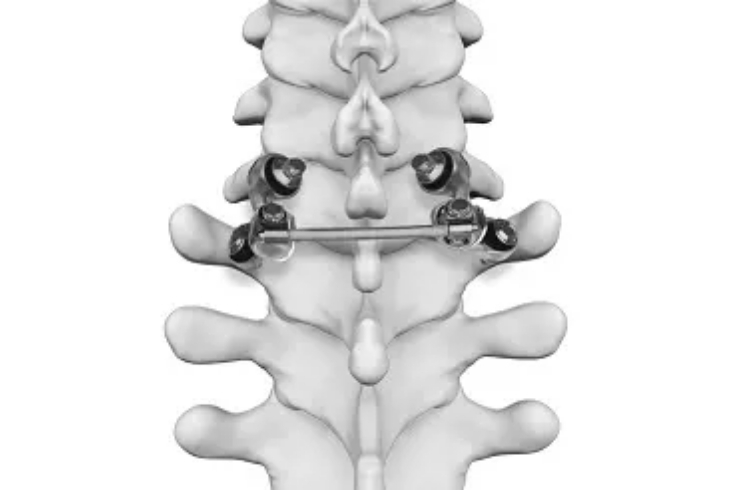 Motion Preserving Spine Surgery