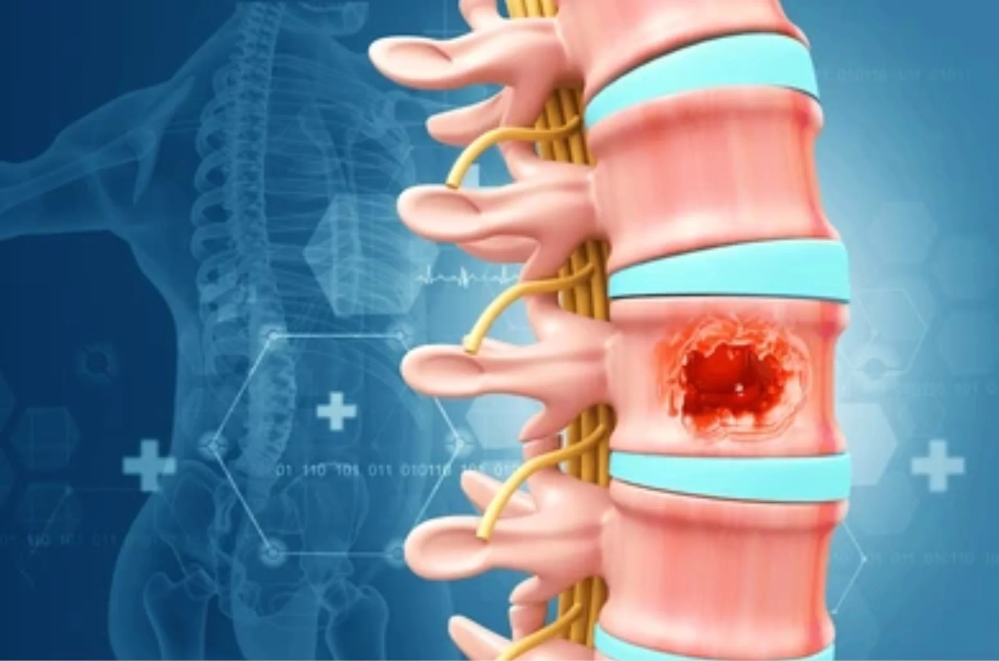Spinal Tumors----05